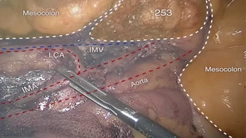 Stoma orifice specimen extraction surgery (SOSES) for rectal cancer and liver resection