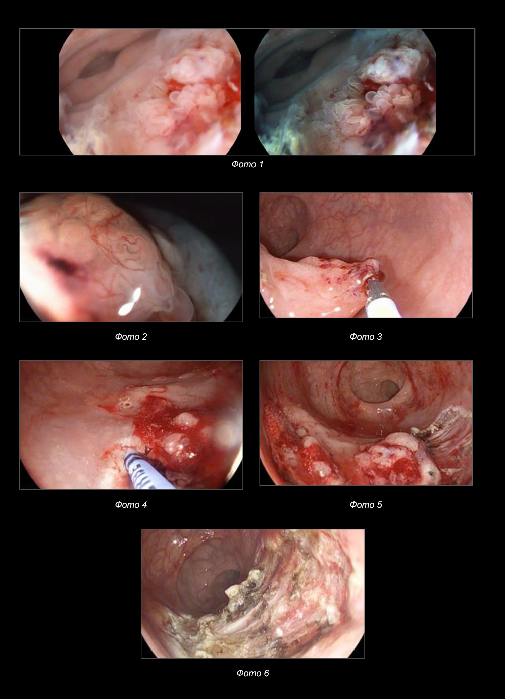 Эндоскопическая мукозэктомия с диссекцией в подслизистом слое по поводу раннего рака прямой кишки.