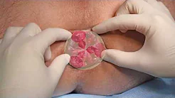Step-by-step open excisional haemorrhoidectomy for grade IV circular haemorrhoidal disease