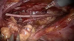 Step-by-step robotic lateral lymph node dissection for rectal cancer