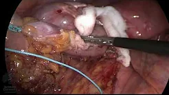 Transrectal Natural Orifice Specimen Extraction after Sigmoidectomy with D2 Lymph Node Dissection