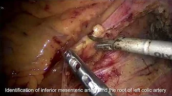 Distal sigmoid colon resection with vascular-oriented D2 lymph node dissection