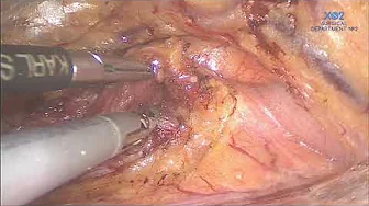 The retroperitoneal approach to vessel-sparing D3-lymph node dissection