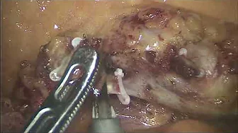 Differences in techniques of artery oriented D3 lymph node dissection for right colon cancer