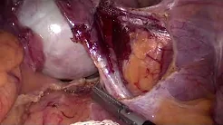 Transanal extraction of 2 specimens after LapRAR with extended D3 lymphadenectomy and ovariectomy
