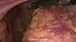 Total proctocolectomy with IPAA and D3 lymph node dissection with IBD-associated colon cancer