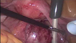 Combined surgical approach for large sacral chordoma resection with pelvic floor reconstruction