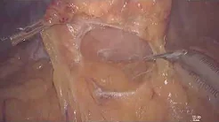 Transrectal Specimen Extraction after Lap Rt Hemicolectomy with Extended D3 Lymph Node Dissection