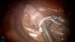 Robotic Transvaginal NOSE Sigmoidectomy with Extended D3 Lymph Node Dissection for Cancer