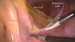 Laparoscopic Dissection of Presacral Cyst and Transvaginal Extraction of the Specimen