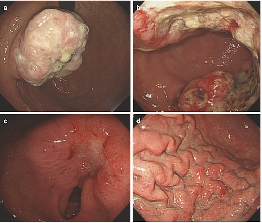 Изменения слизистой оболочки желудка выявляемые при гастроскопии