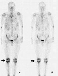 Изображение при остеосцинтиграфии. Стрелочками отмечены зоны  активного накопления радионуклидов костной тканью в суставных концах костей образующих коленные суставы (норма)