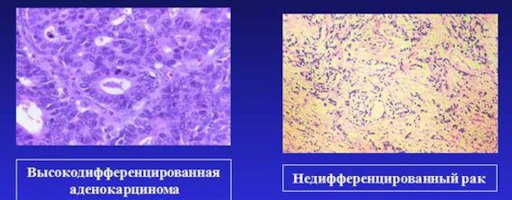 Различные варианты рака желудка (световая микроскопия)